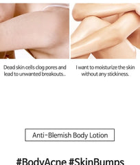 Anti Blemish Body Lotion Back & Chest