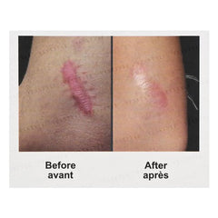 Scar Treatment 2pcs Bundle Set